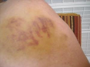 Click image for larger version. 

Name:	45-70 bruise.jpg 
Views:	13 
Size:	25.8 KB 
ID:	308980
