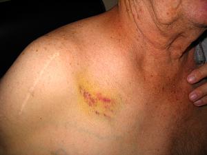 Click image for larger version. 

Name:	bruise...8mm - Copy.jpg 
Views:	40 
Size:	45.9 KB 
ID:	215974